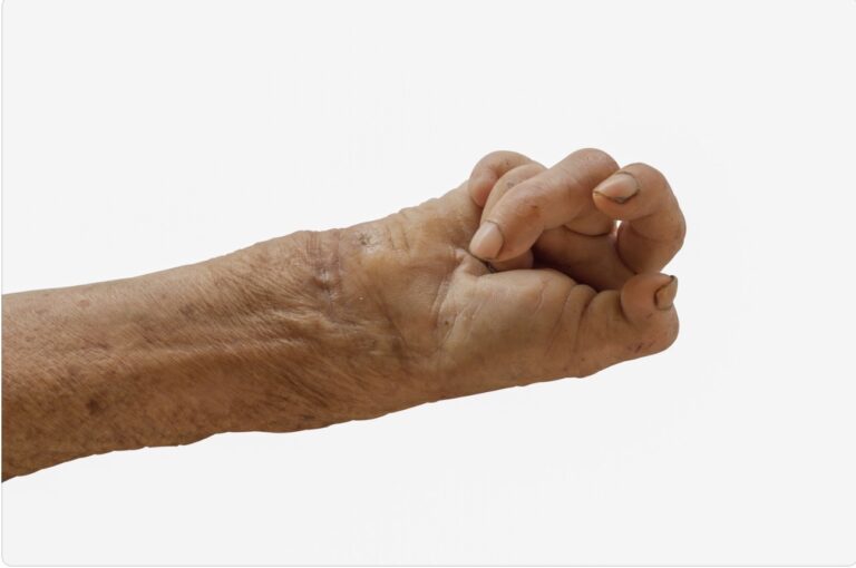 Leprosy