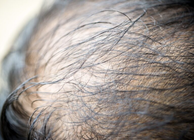 Male baldness