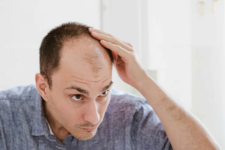 A man touching his thinning scalp