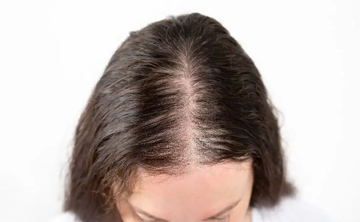 Foundayo Hair Loss
